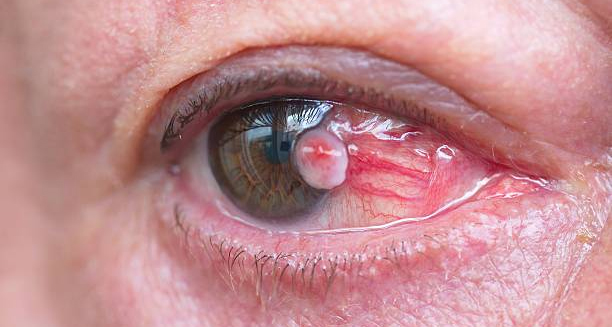 Close-up of eye showing visible tumour from eye cancer