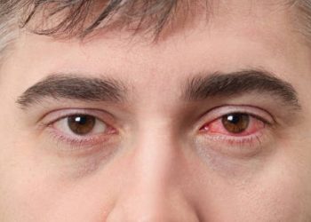 Close-up of a man with red, infected eye