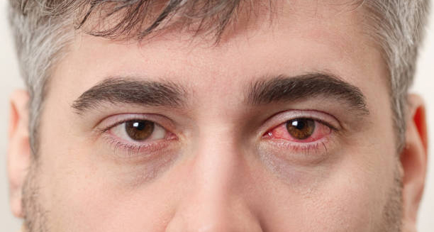 Close-up of a man with red, infected eye