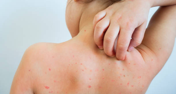 Child scratching red chickenpox rash on back and shoulders