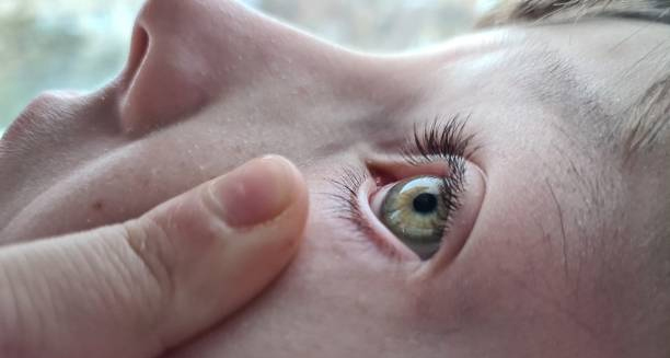 Close-up of a child's eye showing early symptoms of childhood cataracts
