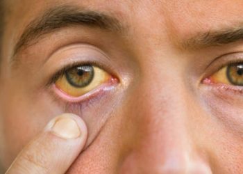 Close-up of jaundiced eyes showing yellowing, a common symptom of cirrhosis.