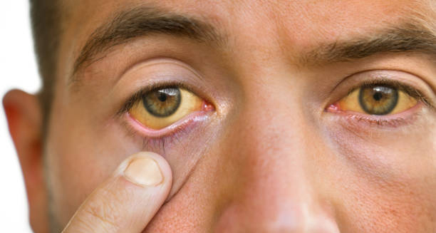 Close-up of jaundiced eyes showing yellowing, a common symptom of cirrhosis.