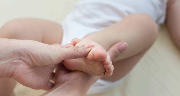 Close-up of a newborn’s foot showing signs of club foot deformity