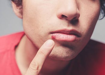 Close-up of a man pointing to a cold sore on his lip