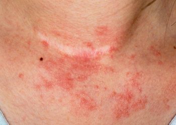 Close-up image of red, inflamed skin rash on the neck, a typical symptom of contact dermatitis