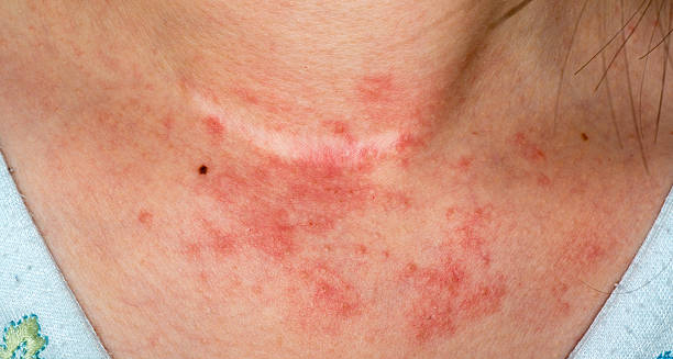 Close-up image of red, inflamed skin rash on the neck, a typical symptom of contact dermatitis
