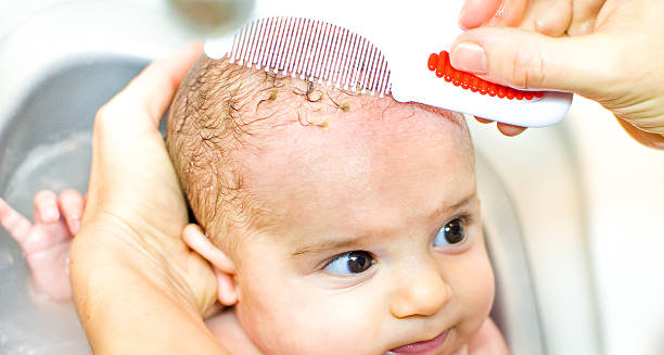 Infant with visible yellowish scales on the scalp being gently combed to manage cradle cap symptoms.