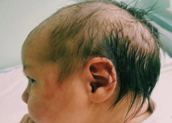 Side profile of an infant with an abnormal head shape and visible ridges on the skull, indicating symptoms of craniosynostosis.