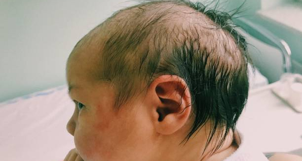 Side profile of an infant with an abnormal head shape and visible ridges on the skull, indicating symptoms of craniosynostosis.