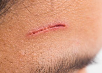 Close-up of a shallow cut on a person’s forehead with mild redness.