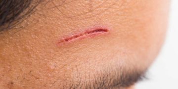 Close-up of a shallow cut on a person’s forehead with mild redness.