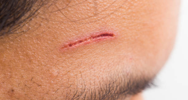 Close-up of a shallow cut on a person’s forehead with mild redness.