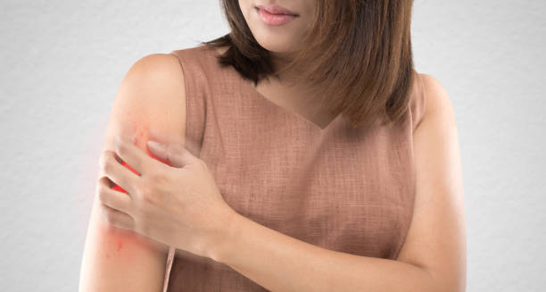Woman scratching red itchy rash on her upper arm