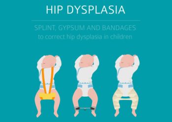 Illustration of infants with hip dysplasia braces