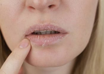 Woman with dry, cracked lips from dehydration