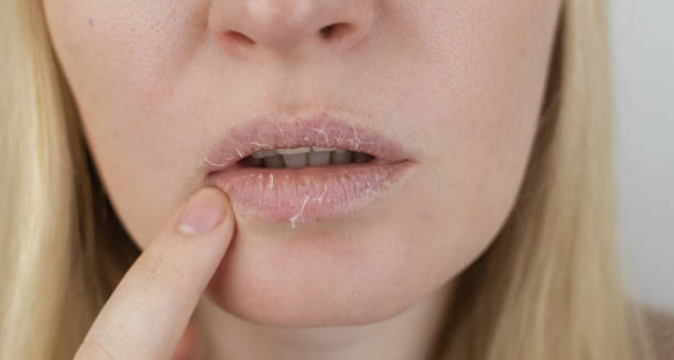 Woman with dry, cracked lips from dehydration