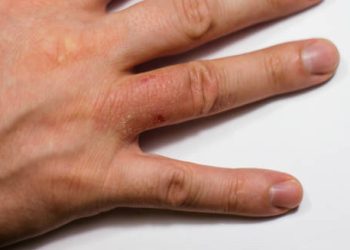 Close-up of red, inflamed patches on a hand showing symptoms of discoid eczema