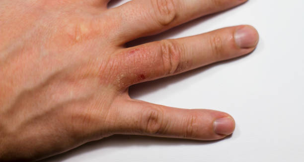Close-up of red, inflamed patches on a hand showing symptoms of discoid eczema