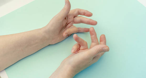 Hands showing bent fingers due to Dupuytren’s contracture symptoms