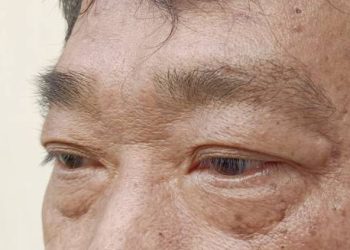 Man with visible eye irritation and sagging lower eyelids, a common symptom of ectropion.