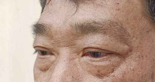 Man with visible eye irritation and sagging lower eyelids, a common symptom of ectropion.
