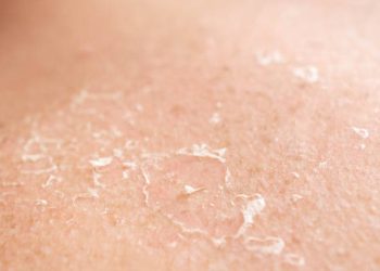 Symptoms of Epidermolysis Bullosa