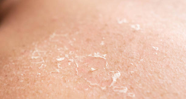 Symptoms of Epidermolysis Bullosa