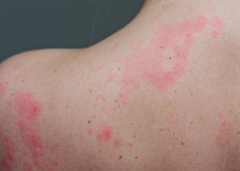 Red patches and irritation on the upper back due to erythromelalgia symptoms