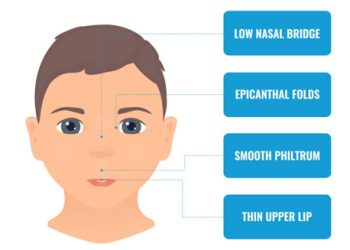 Facial features indicating Fetal Alcohol Spectrum Disorder in a child