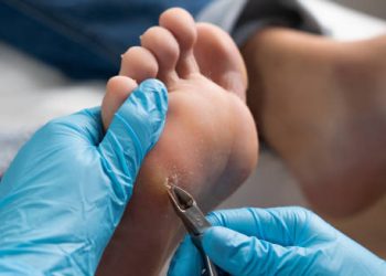 Podiatrist removing callus from foot using a scalpel