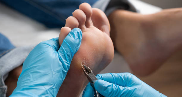 Podiatrist removing callus from foot using a scalpel