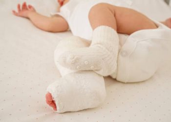 Infant in white onesie with both feet in corrective plaster casts for club foot