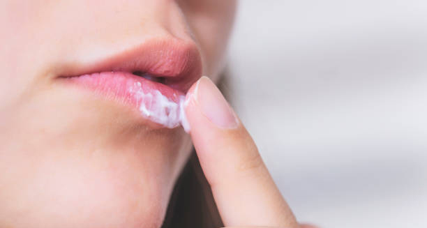 Woman applying cream to cold sore on lip