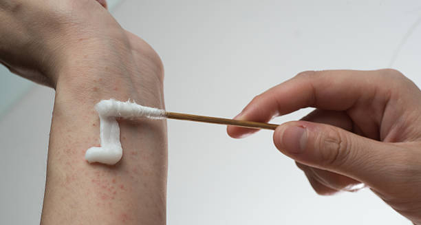 Applying topical cream to an irritated wrist showing signs of contact dermatitis.