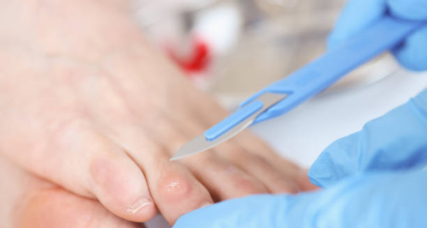 Close-up of a medical professional using a scalpel to remove a corn from a patient’s toe.
