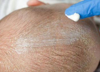 Close-up of a baby’s scalp with visible cradle cap being treated with a topical cream applied by a gloved hand.
