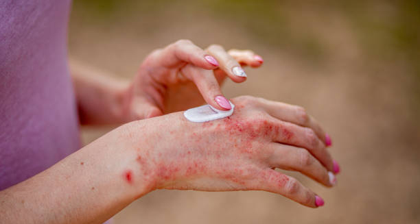 Treatment of Discoid Eczema