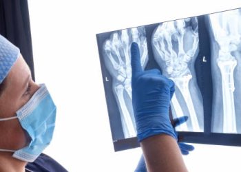 Treatment of Dupuytren’s Contracture with wrist X-ray examination