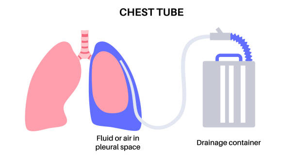 Treatment of Empyema