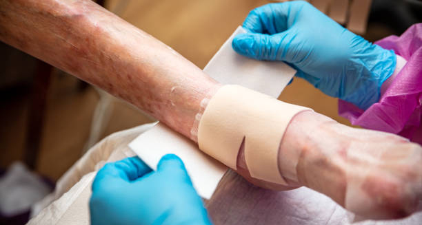 Medical professional applying bandages to fragile skin affected by Epidermolysis Bullosa