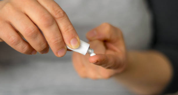 Person applying topical cream from a small tube as treatment for erythema multiforme