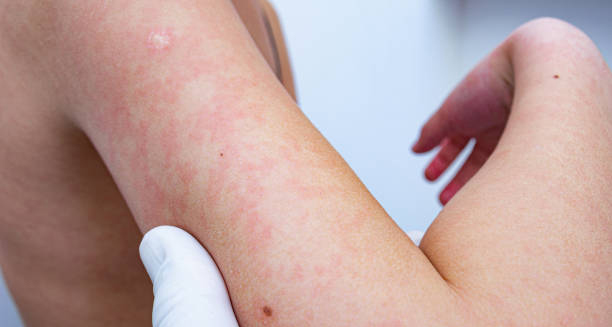 Medical professional examining erythema nodosum on a patient’s arm