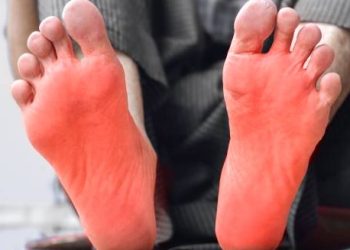 Person with visibly red, inflamed soles of feet raised for cooling, representing erythromelalgia treatment