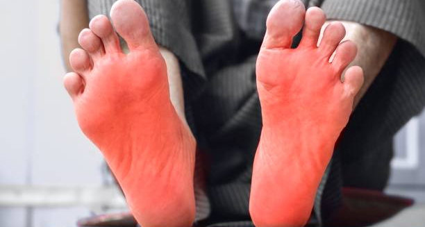 Person with visibly red, inflamed soles of feet raised for cooling, representing erythromelalgia treatment