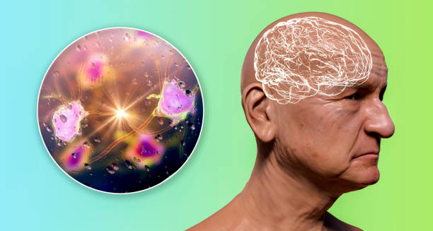 Illustration of an elderly man with neural activity and brain degeneration linked to frontotemporal dementia