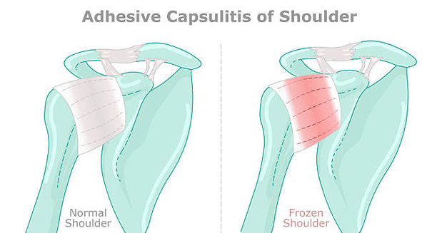 Medical diagram comparing a normal shoulder to a frozen shoulder showing adhesive capsulitis
