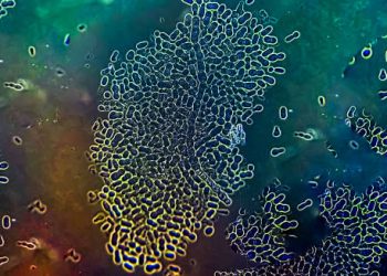 Microscopic view of fungal organisms causing nail infection