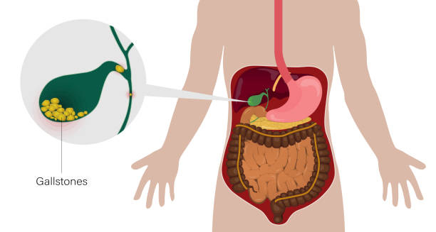 Diagram showing gallstones forming in the gallbladder and their location in the human digestive system
