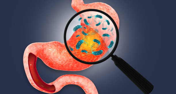 Bacterial infection in the stomach causing gastritis